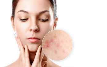 علاج فعّال لحب الشباب وآثاره باستخدام تقنيات طبية متقدمة تعيد لبشرتك نقاءها الطبيعي.